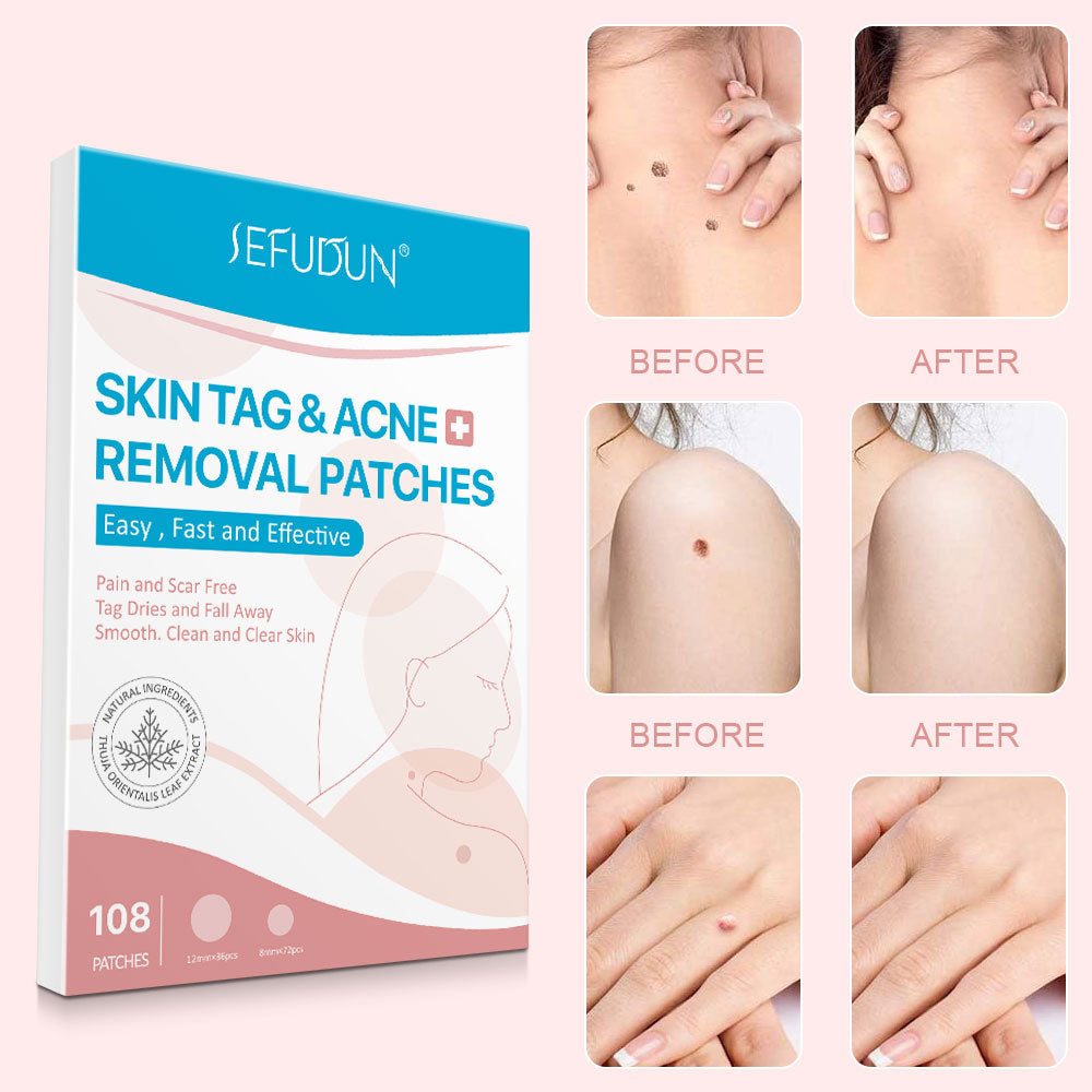 Patch visage anti-acné et boutons noirs, stickers de soin invisibles pour éliminer les imperfections de la peau.