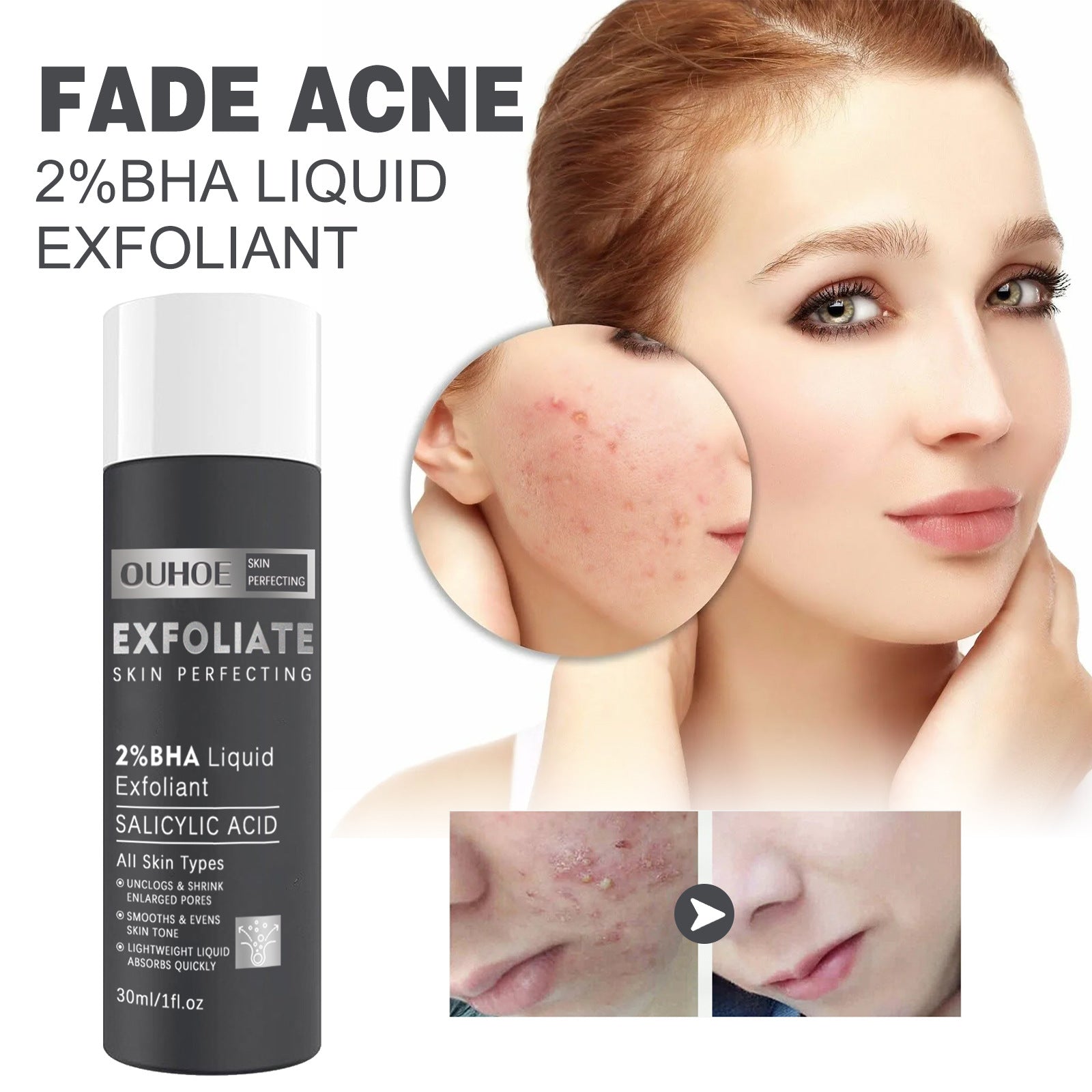 Eau de soin pour la peau à base de salicylate, destinée à réparer la peau acnéique, dans un flacon transparent.